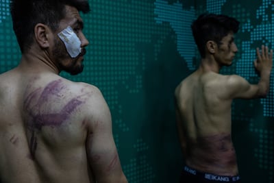Nehmatullah Naqdi (left) and Taqi Daryabi show their scars from the Taliban beatings.