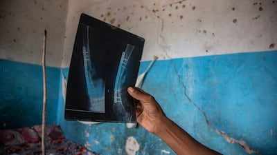 Khalifa Ibrahim shows an image of his X-ray at the camp. Getty