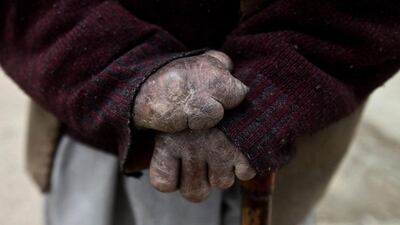 Leper patient Mia Khatana holds his walking stick.