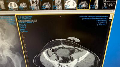 An x-ray from March 24 showing the fracture of Adeeb Sami’s hip bone. Courtesy Adeeb Sami