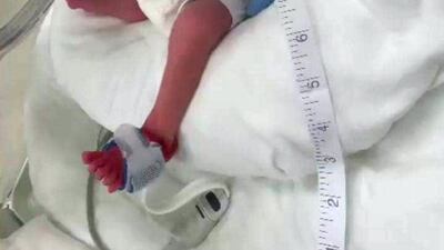 Arriving two months early, Mia was placed in the hospital’s neonatal intensive care unit where she has been for almost six weeks. Courtesy: Father, Jeremy