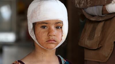 An injured girl after alleged Pakistani air strikes in Kabul, Afghanistan. EPA