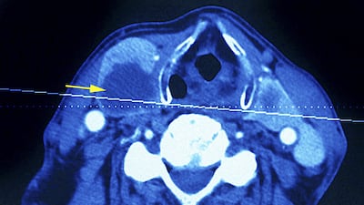 A CT scan of a patient's neck (not the writer's) reveals a thyroid tumour (Photo By BSIP/UIG Via Getty Images)
