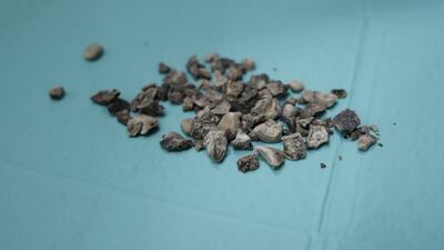 A Pakistani man is recovering after doctors removed 200 stones from his kidney. Photo: Burjeel Hospital