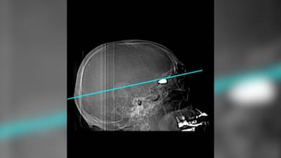 Many young protesters in Iran have been shot in the head, US-based doctor says