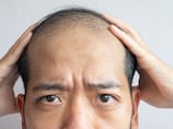 Scientists comb through research for milestone cure for male baldness