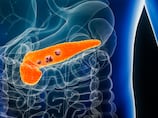AI tool helps detect pancreatic cancer up to three years before diagnosis, study finds